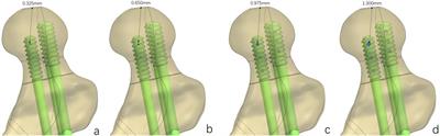 Biomechanical optimization of the magnesium alloy bionic cannulated screw for stabilizing femoral neck fractures: a finite element analysis